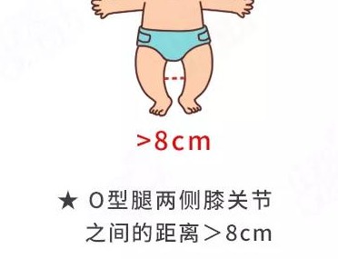 宝宝腿纹不对称,难道是髋关节发育不良