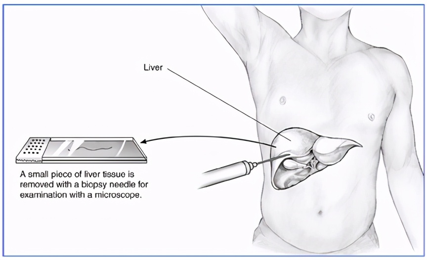 转氨酶高，该怎么办？如果你有肝损伤，请收下这篇雨露均沾的科普