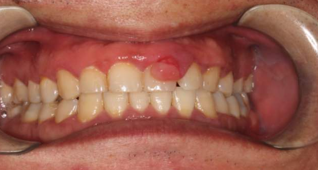 牙龈增生和牙龈瘤图片图片