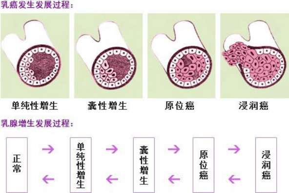 乳房隐隐作痛还有肿块，忍一忍就算了？乳腺结节这种情况可不能忍