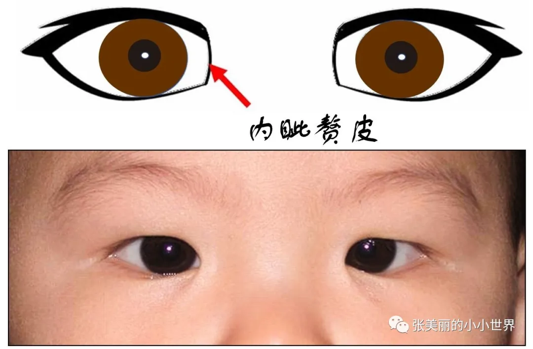 “斗鸡眼”就是斜视吗?快拿家里的手电筒试一试