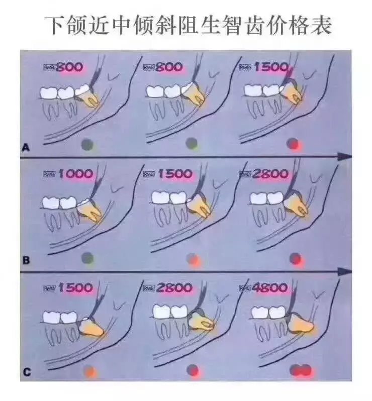 一起去拔智齿,为啥收费差别这么大?拔智齿按什么标准收费的?