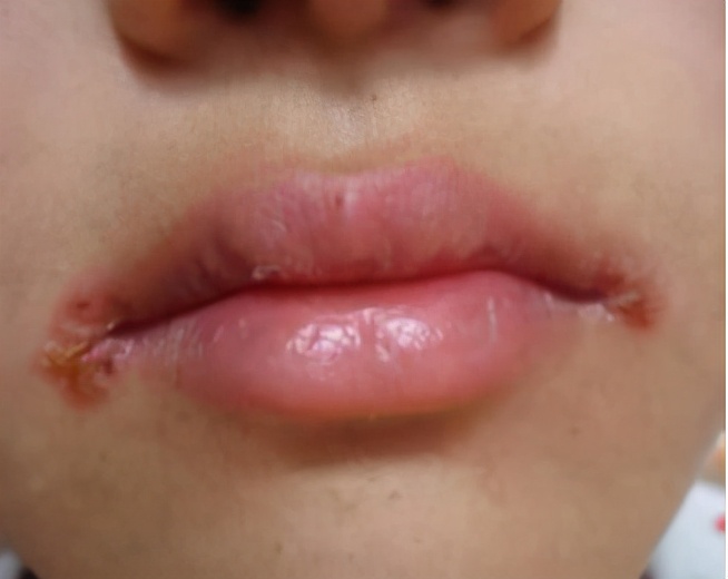 婴儿口角炎图片(嘴角发红) - 乐宝宝贝