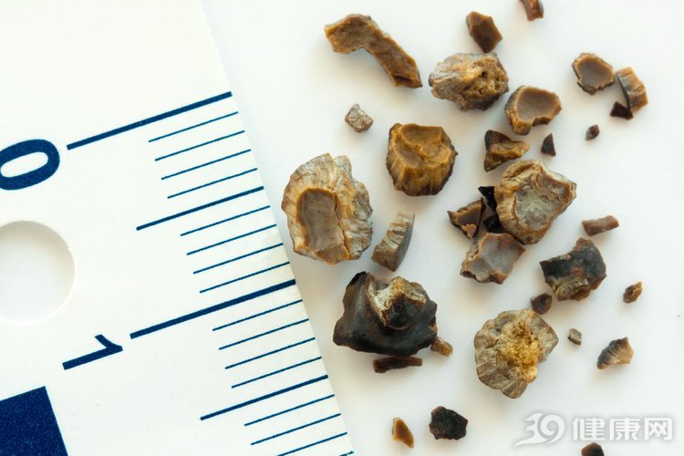 体检查出肾结石，先别慌：3个方法，或可让肾结石离开身体