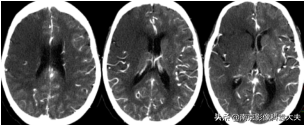 中国脑血管病影像指导手册解读（19年5月版）之急性缺血卒中评估