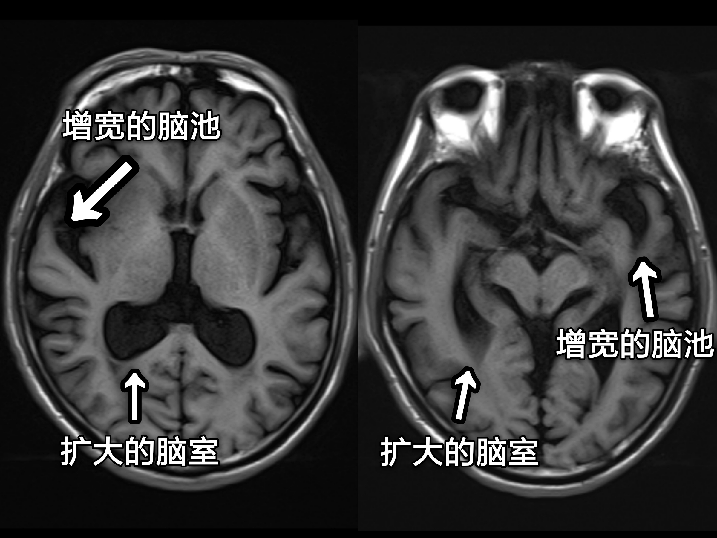 什么是脑萎缩？发现脑萎缩后，应该怎么办？#全国两会健康中国人#