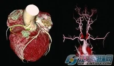 似疑冠心病，可以用冠脉CTA筛查