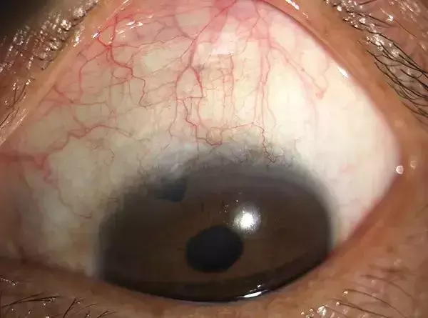 有一种眼出血看起来很吓人，其实没有危险