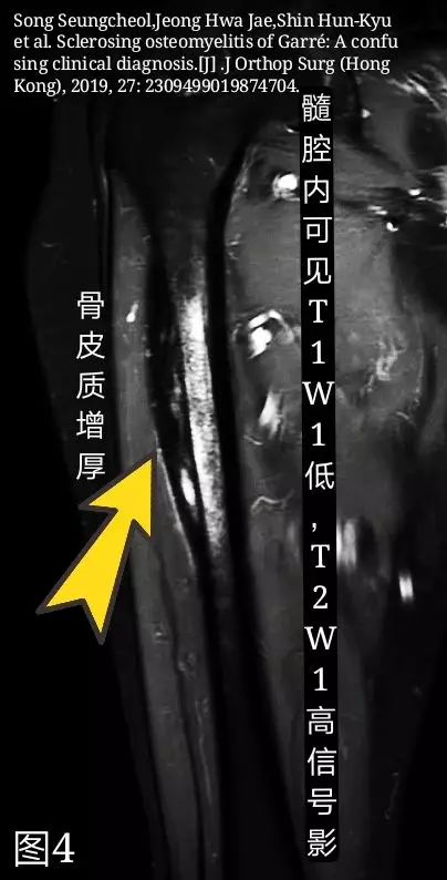 常见易误诊:硬化性骨髓炎的诊断和治疗技巧,看这篇