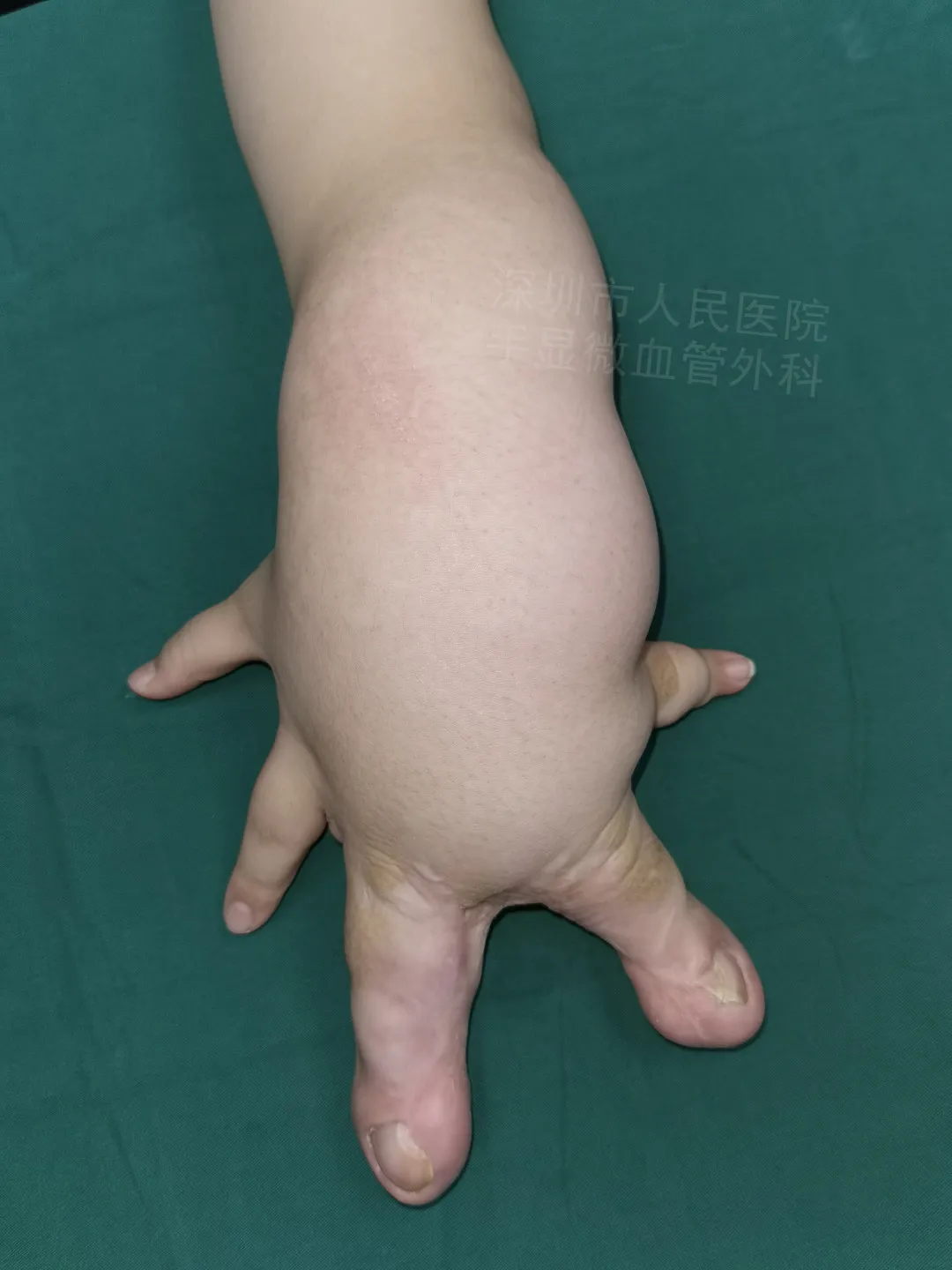 得了这病，12岁男孩手指比香蕉还粗！7种常见的手部畸形，家长们要注意