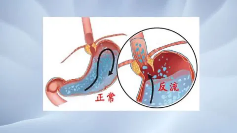 反流性食管炎中成药治疗困境与突破：十大常用药及新疗法探析