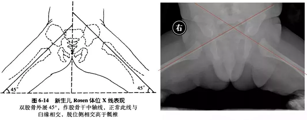 宝宝臀纹不对称妈妈不上心，长大后孩子走路一瘸一拐