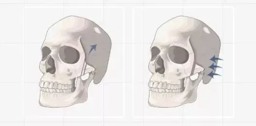 颧骨内推后会下垂吗？