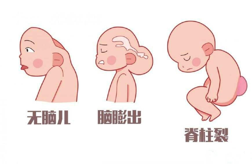 千万不要小看先天性脊柱裂!早期发现蛛丝马迹,对症治疗是关键