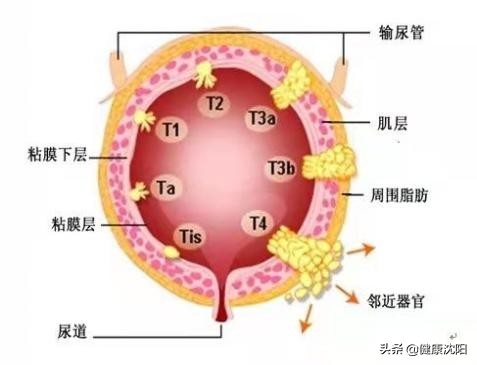 世界男性健康日 | 得了膀胱癌复查仅做膀胱镜就够了吗？