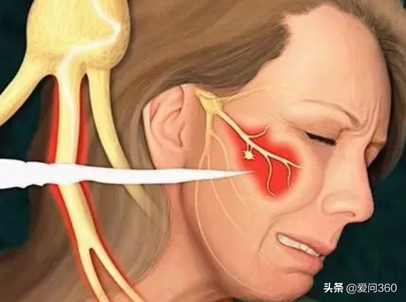 三叉神经痛实在太疼，这些原因要知道，如何缓解？