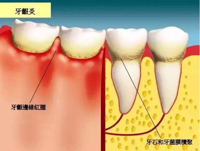 牙龈萎缩不容小觑,不但不可逆治疗起来也难,出现苗头要及早警惕
