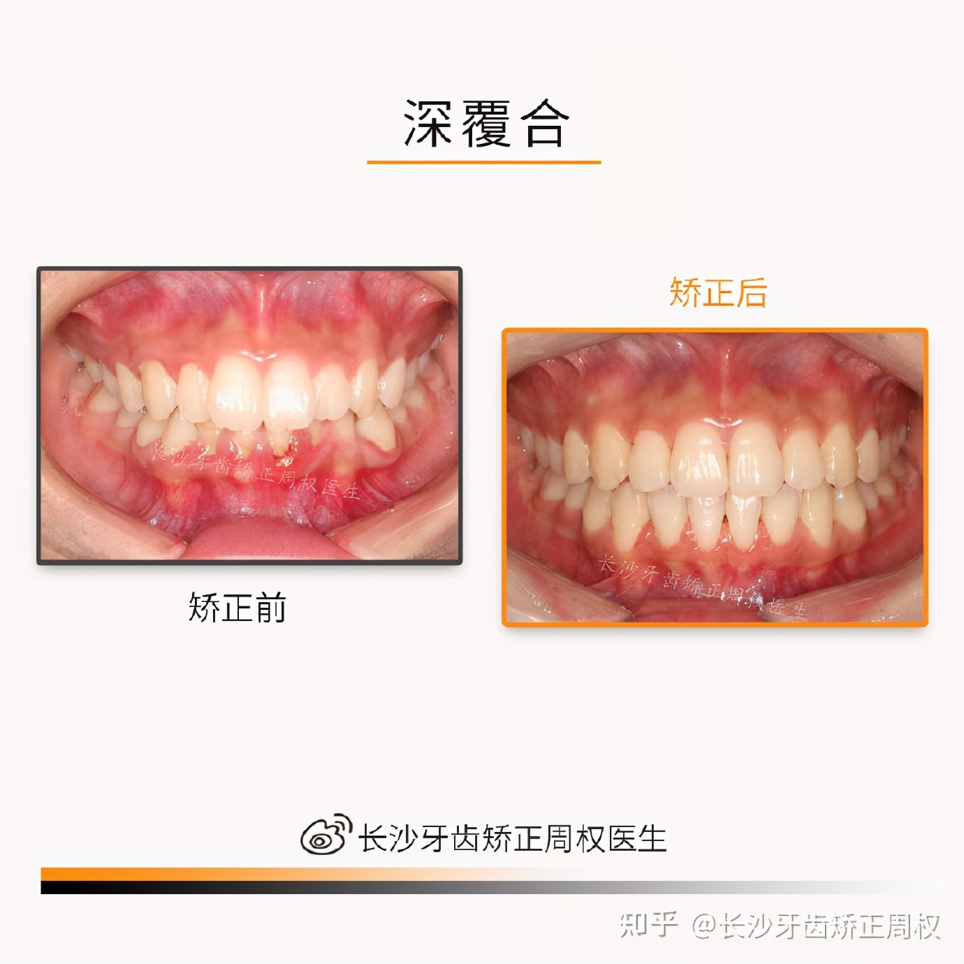 长沙牙齿矫正｜正畸合集：牙齿拥挤、龅牙、地包天、深覆合