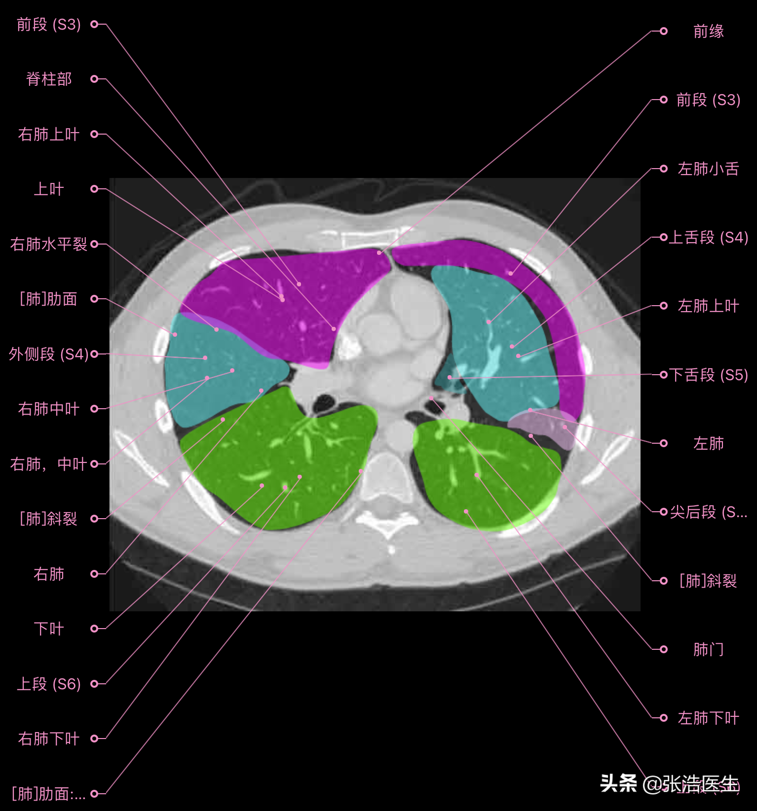 肺部ct高清解剖圖譜,附帶詳細標註