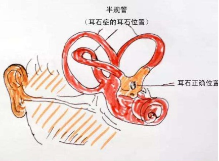耳石症自我复位法图解什么是耳石症