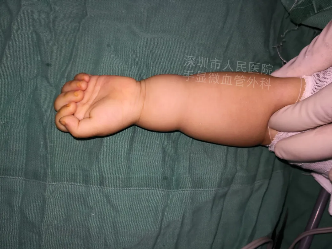 得了这病，12岁男孩手指比香蕉还粗！7种常见的手部畸形，家长们要注意