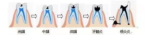 补牙花了2W多亏吗？越早治疗越省钱！#雅悦齿科#