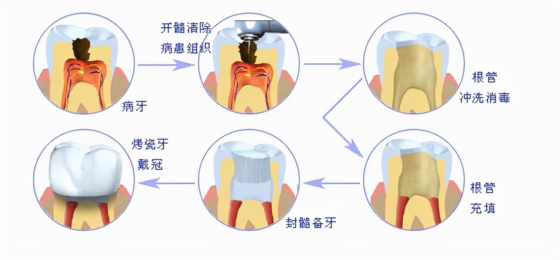 烤瓷牙虽好，也不要乱镶！使用烤瓷牙这几个禁忌必须了解清楚