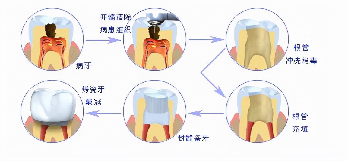 烤瓷牙虽好，也不要乱镶！使用烤瓷牙这几个禁忌必须了解清楚