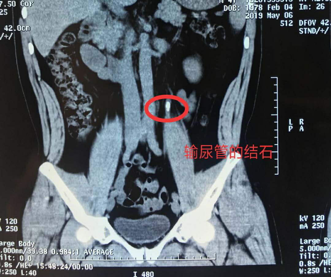 细说尿路结石溶石治疗：除了手术以外，另一种选择