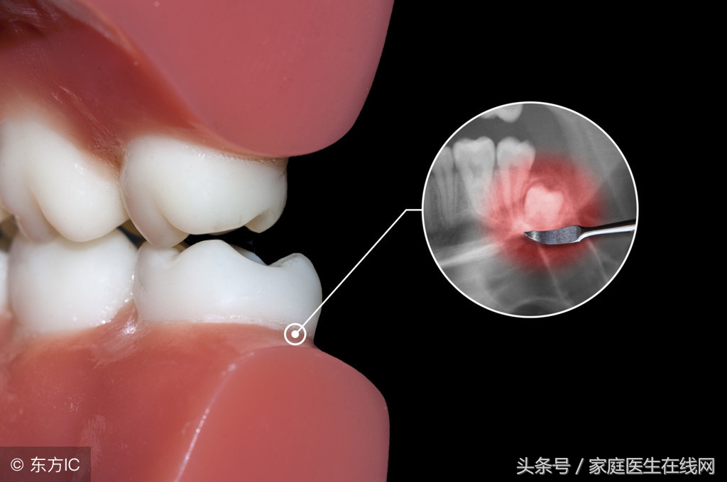 長智齒對身體的影響有3個,這種情況的智齒,早拔早好