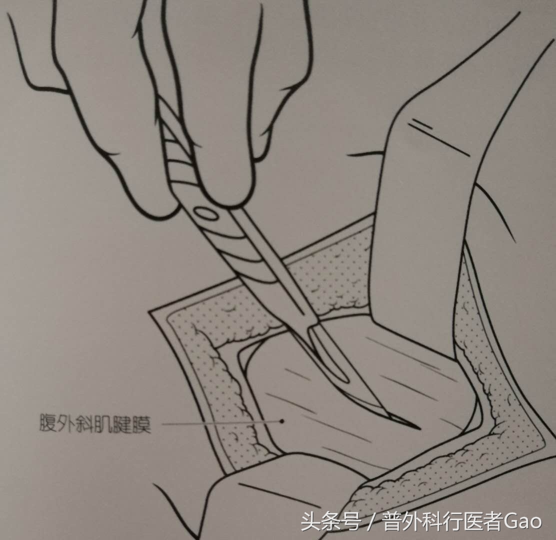 杏仁:一图一话全面解析阑尾的切除过程(干货,不懂医也学习了)