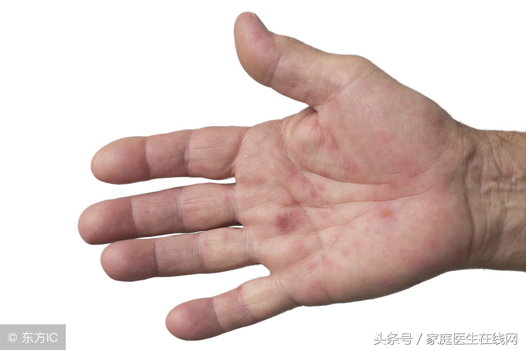 得了手足口病，會有這4個典型症狀出現，一看就清楚