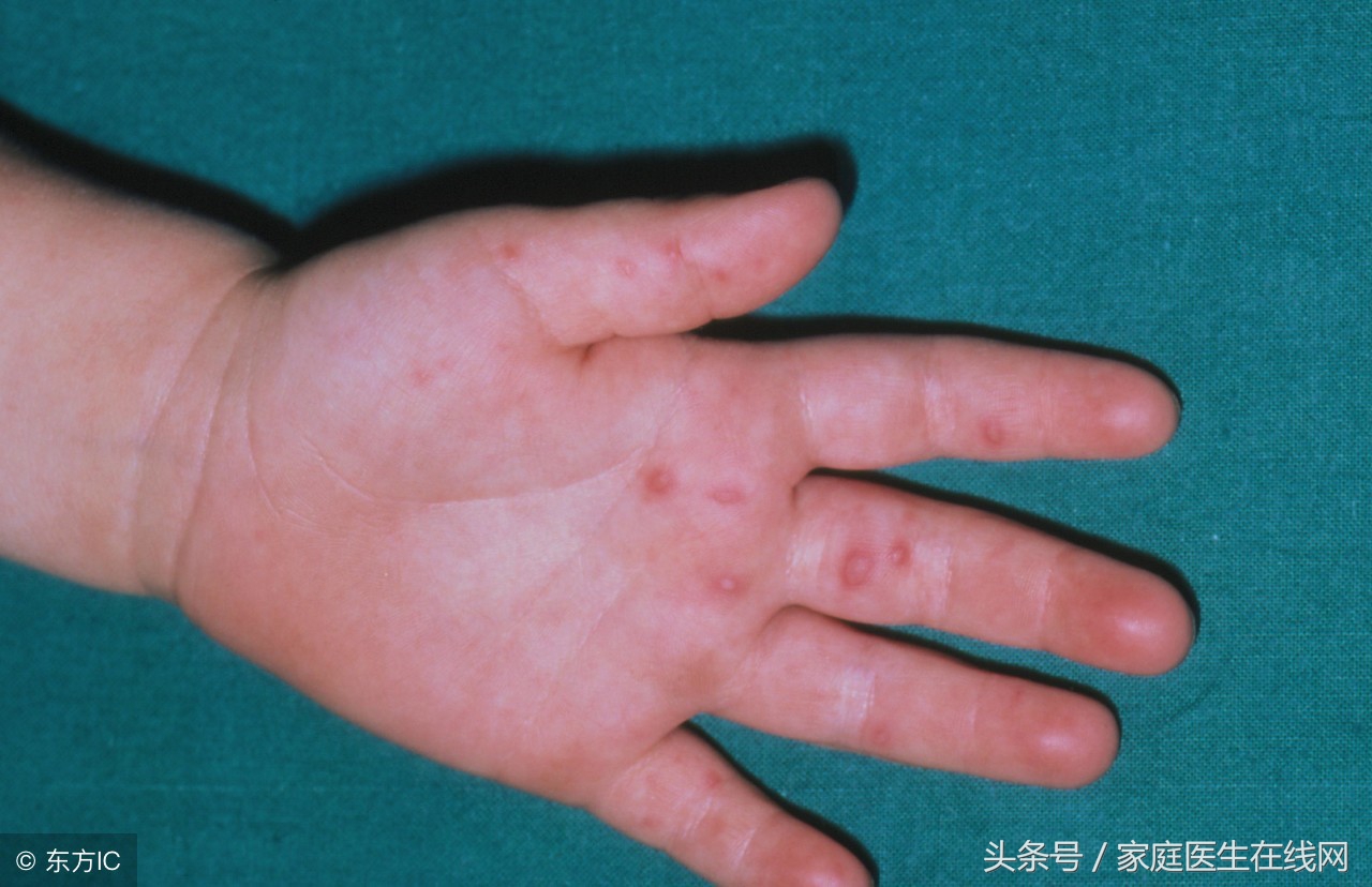 得了手足口病，會有這4個典型症狀出現，一看就清楚
