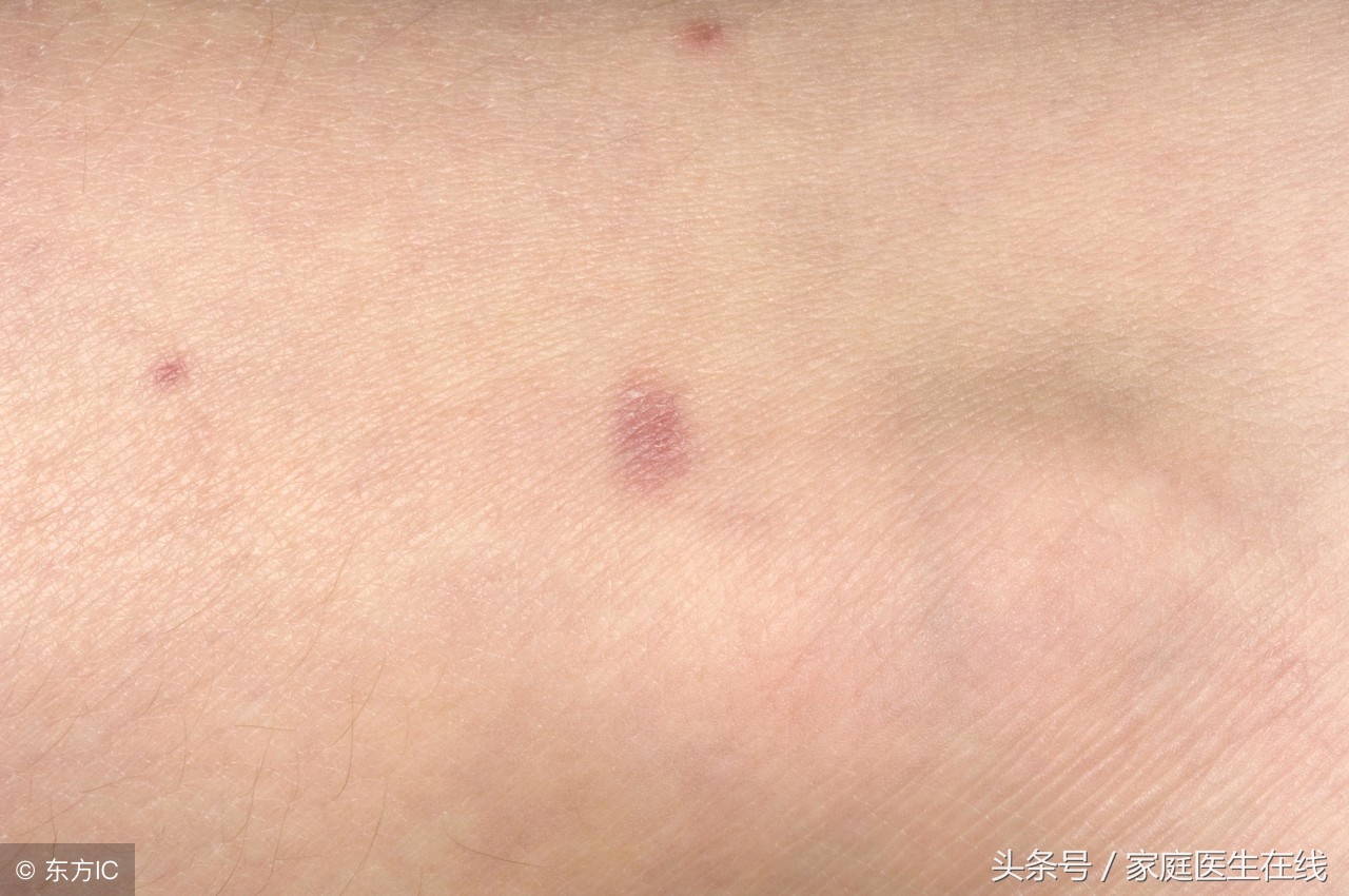 如果家人患上过敏性紫癜，应该怎么调理？送你3个小方