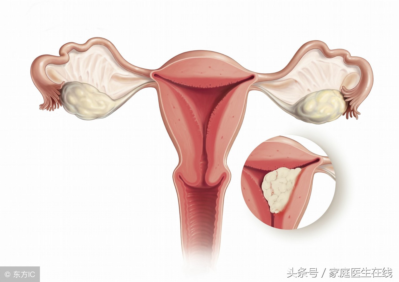 妇科医生：子宫肌瘤的形成，与这个激素有一定的关联