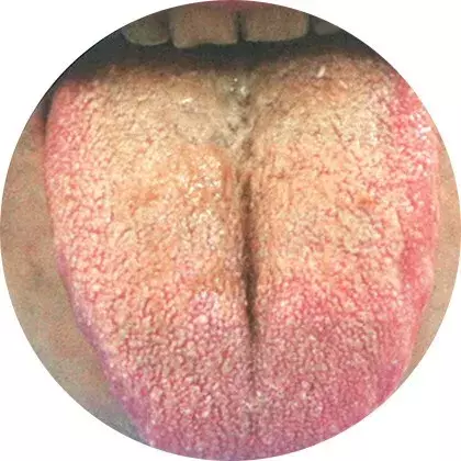 舌尖,舌中,舌两边有红点,芒刺,分别代表心火亢盛,胃肠热盛,肝胆火旺.