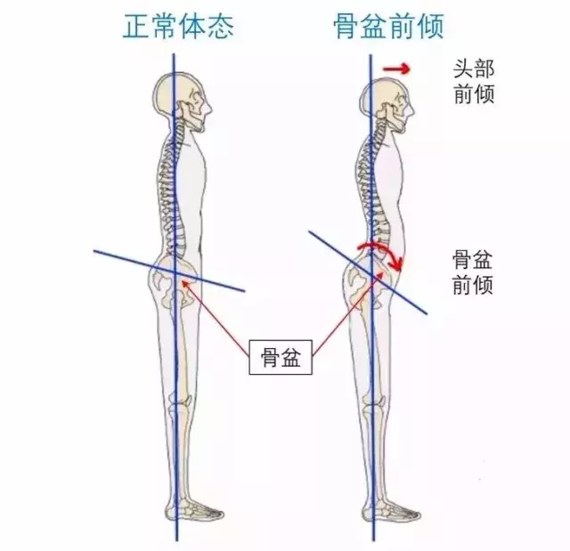 骨盆前倾的成因分析及对身体的危害影响