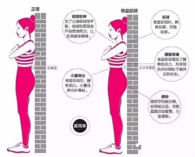 骨盆前倾的原因及危害