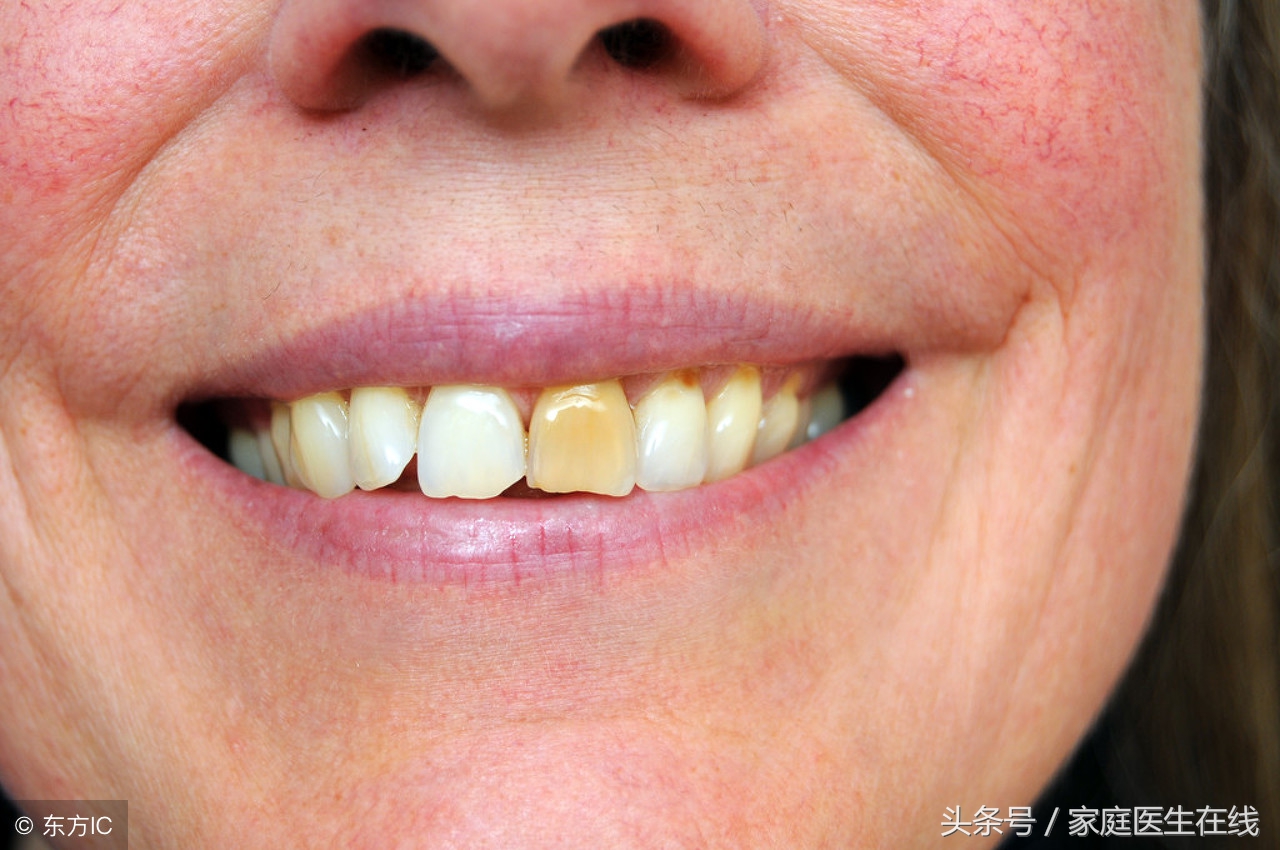 牙齿黄的人如何成功“洗白”？这两种方法，值得收藏