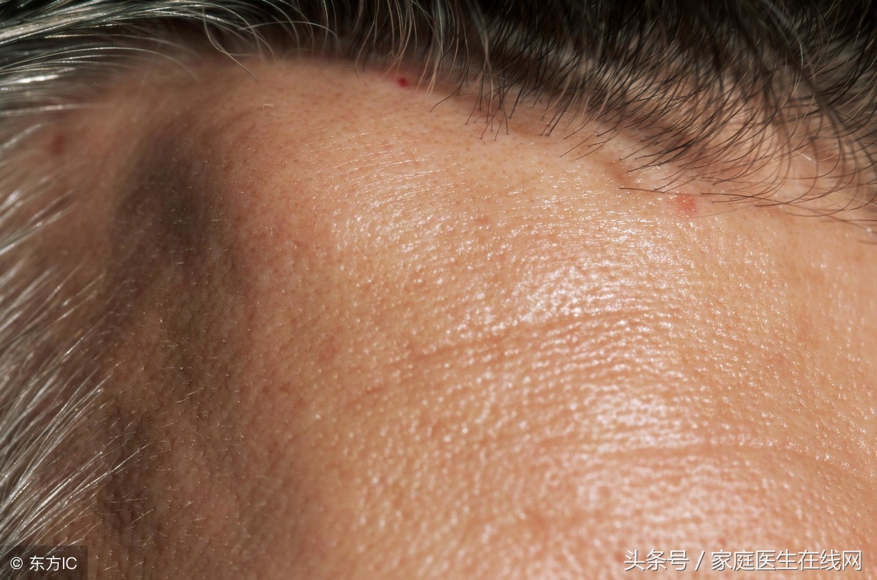 脂肪瘤会不会恶变成癌症？明白其中道理，扫除心中疑虑