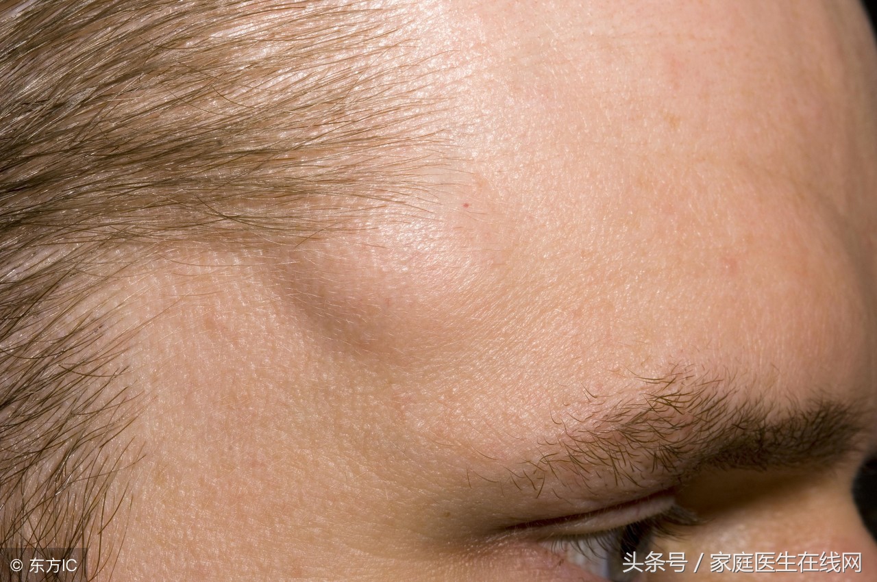 脂肪瘤会不会恶变成癌症？明白其中道理，扫除心中疑虑