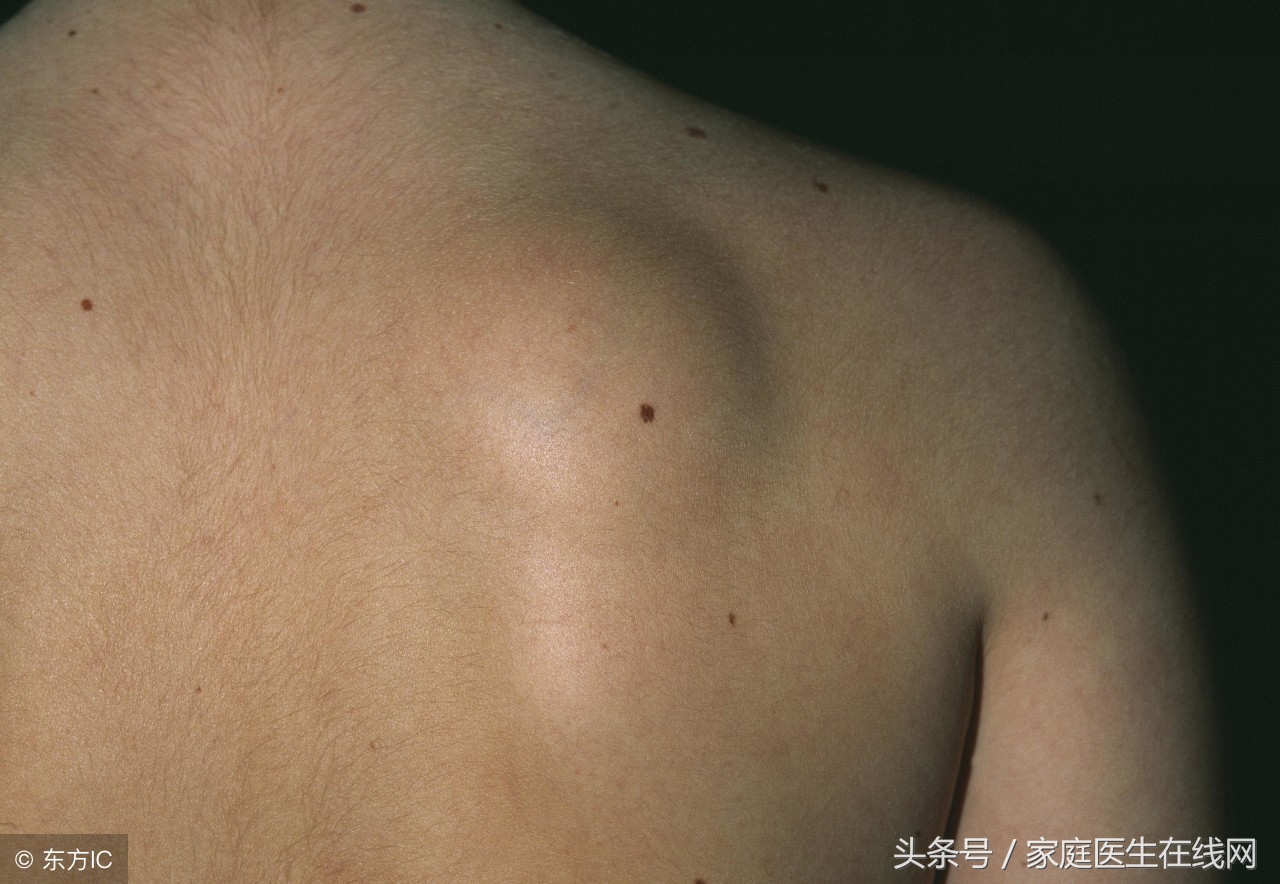 脂肪瘤会不会恶变成癌症？明白其中道理，扫除心中疑虑
