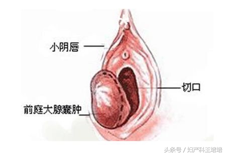 关于前庭大腺囊肿的那些事！