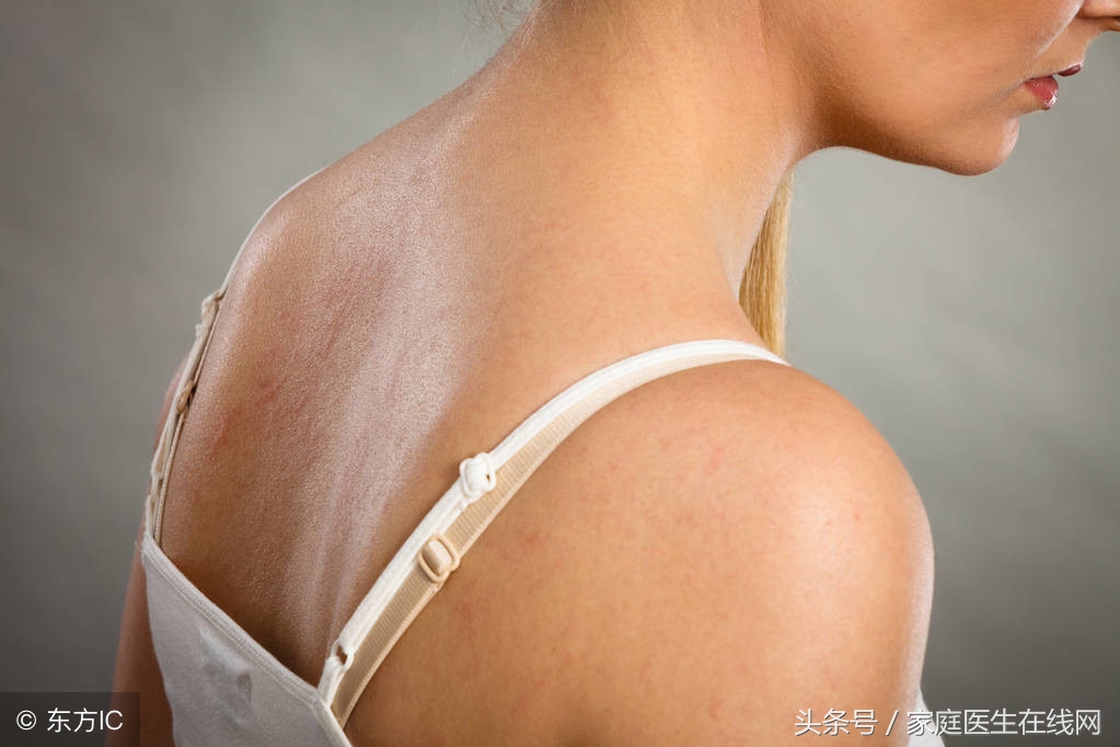 后背上长了很多痘痘，该怎么办？做好这些事，不用太发愁