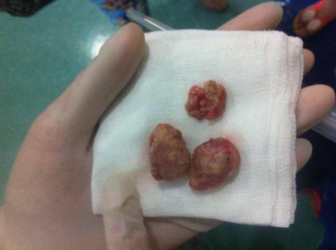 什么时候可以切除扁桃体?会对身体有哪些影响?