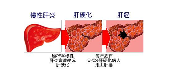 转氨酶长期居高不下，谨防肝病肝炎，1碗汤可快速降酶，保肝健康