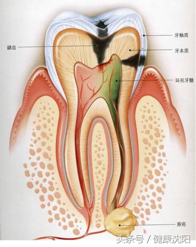 健康科普堂｜牙髓炎的治疗和预防