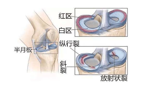 为什么nba这么多人半月板撕裂(“半月板”的伤有多少球员能挺过？韦德算个奇迹，大多数黯然退役)