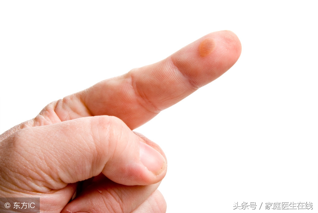 烫伤起水泡怎么办？能不能挑破？正确处理方法须知