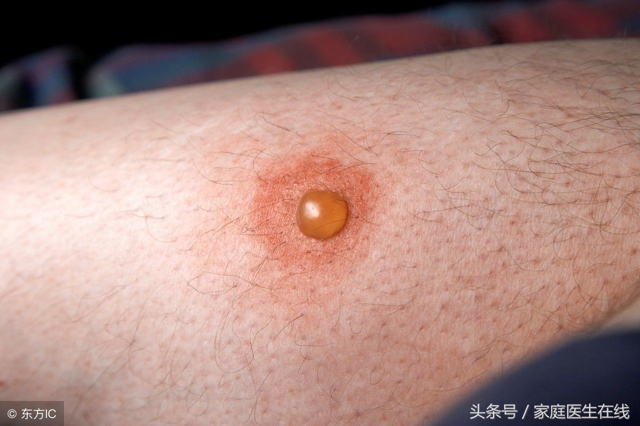 烫伤后水泡能不能挑？要分情况，这篇文章详细清楚告诉你